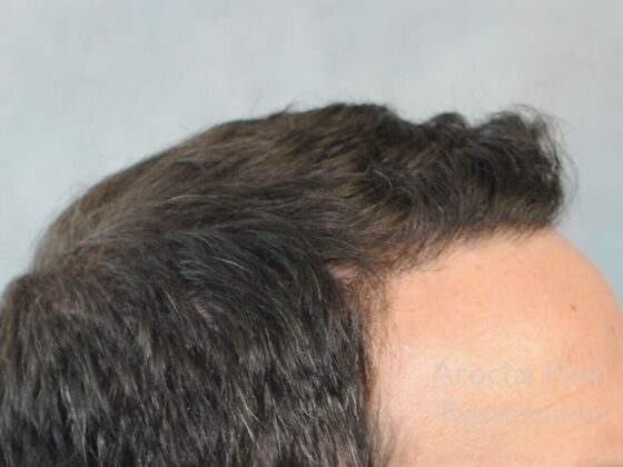 FUT Hair Restoration: Case 41 - After