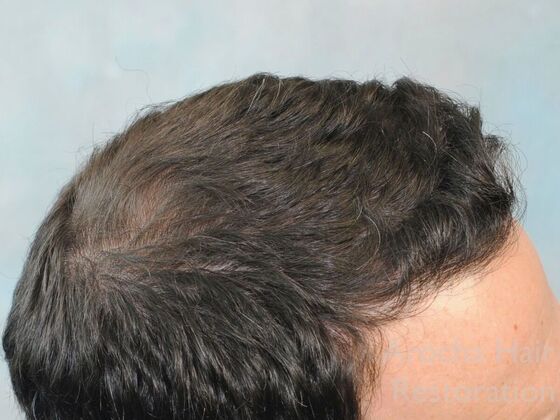 FUT Hair Restoration: Case 41 - After