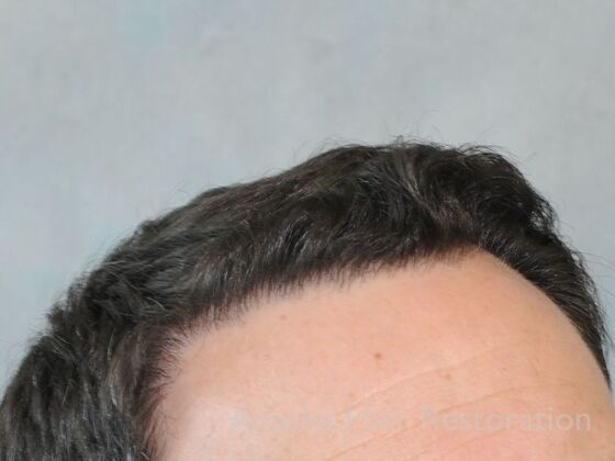 FUT Hair Restoration: Case 41 - After
