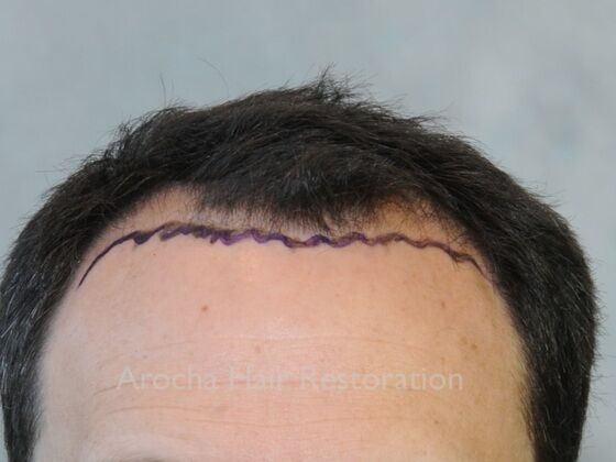 FUT Hair Restoration: Case 41 - Before