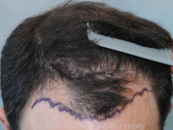 FUT Hair Restoration Case 41 - Before