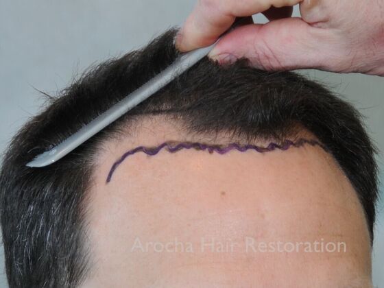 FUT Hair Restoration: Case 41 - Before