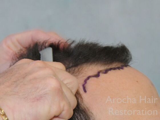 FUT Hair Restoration: Case 41 - Before