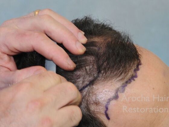 FUT Hair Restoration: Case 41 - Before