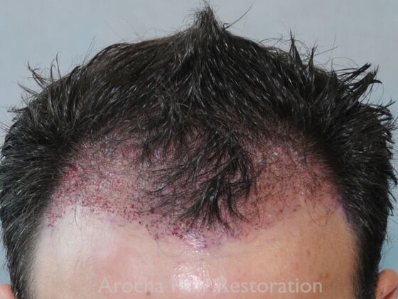 FUT Hair Restoration: Case 41 - After