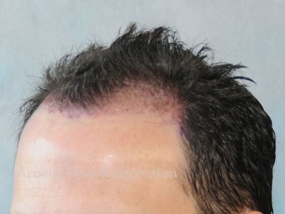 FUT Hair Restoration: Case 41 - After