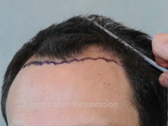 FUT Hair Restoration: Case 41 - Before