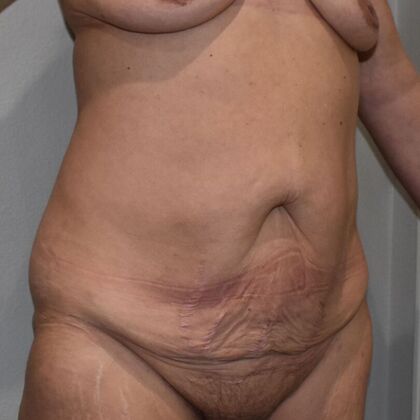 Tummy Tuck (Abdominoplasty): Case 477 - Before