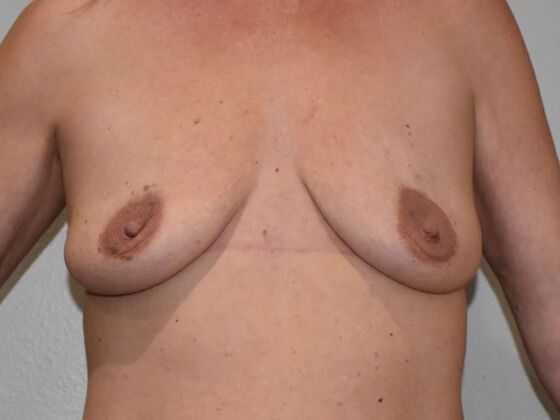 Breast Augmentation w/ Lift: Case 532 - Before