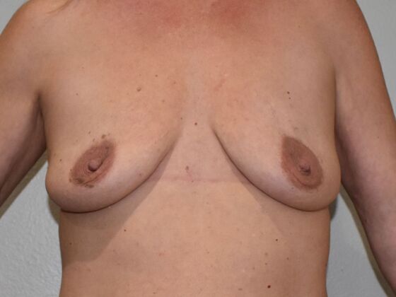 Breast Augmentation Case 760 - Before
