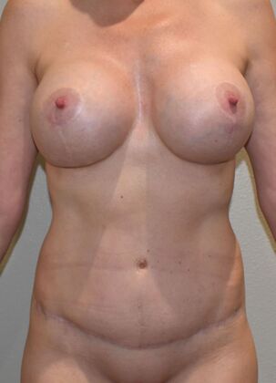 Mommy Makeover Case 15a - After