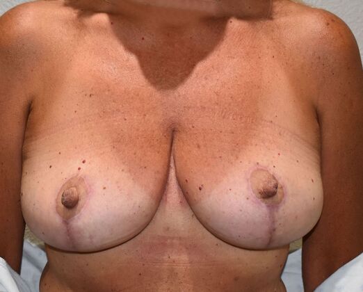 Breast Lift (Mastopexy) Case 189 - After