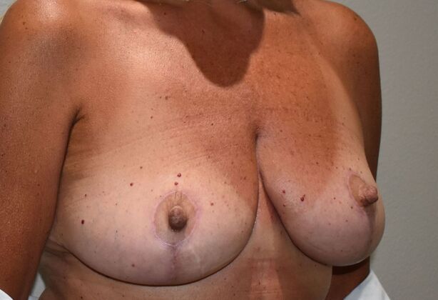 Breast Lift (Mastopexy): Case 189 - After