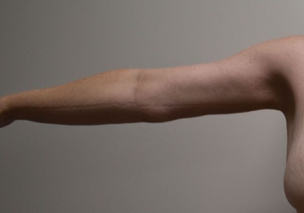 Brachioplasty Case 19 - After