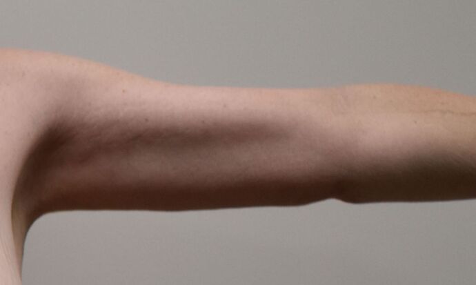 Brachioplasty: Case 19 - After