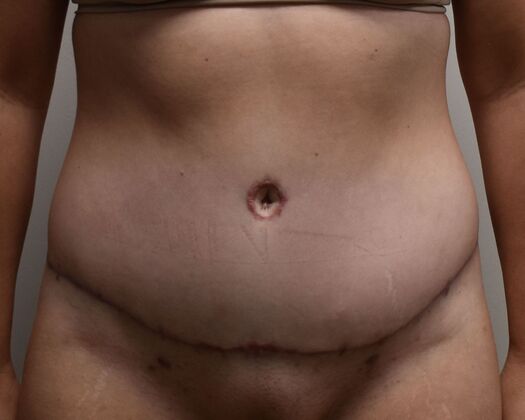 Tummy Tuck (Abdominoplasty): Case 476 - After
