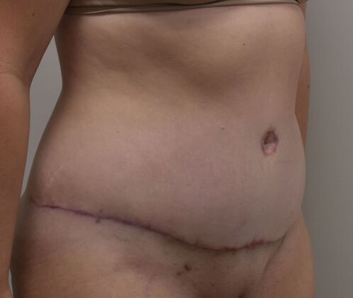 Tummy Tuck (Abdominoplasty): Case 476 - After