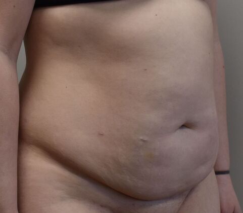 Tummy Tuck (Abdominoplasty): Case 476 - Before