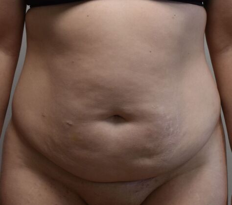 Tummy Tuck (Abdominoplasty): Case 476 - Before