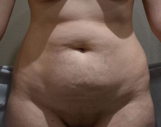 Tummy Tuck (Abdominoplasty): Case 478 - Before