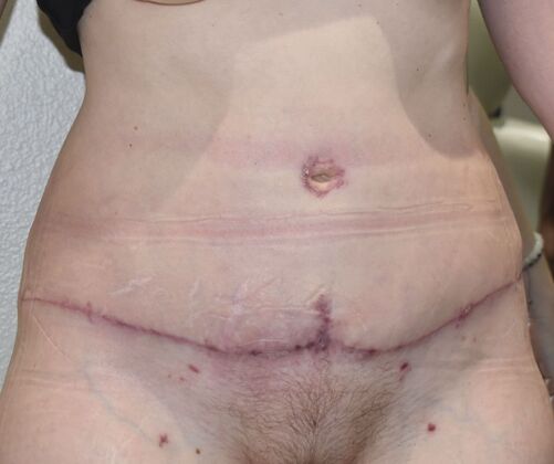 Tummy Tuck (Abdominoplasty): Case 478 - After