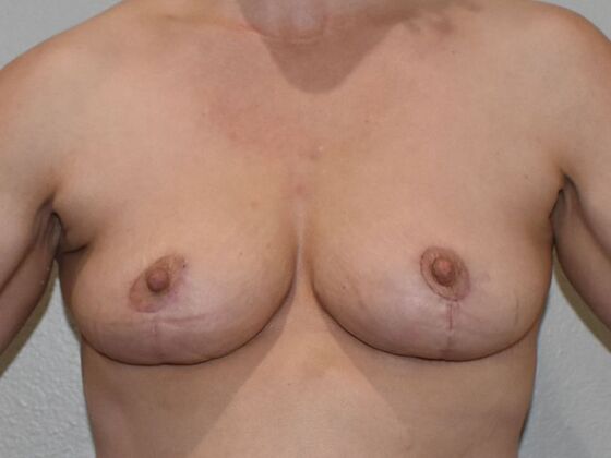 Breast Lift (Mastopexy) Case 186 - After