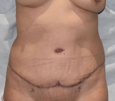 Tummy Tuck (Abdominoplasty): Case 479 - After
