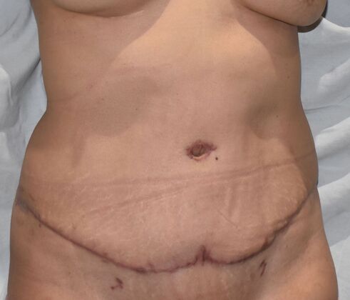 Tummy Tuck (Abdominoplasty): Case 479 - After