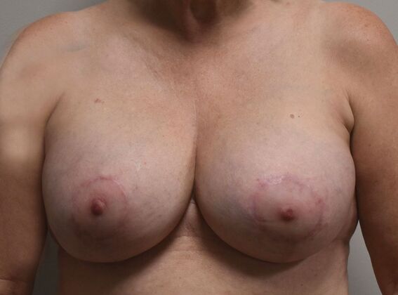 Breast Revision: Case 247 - After