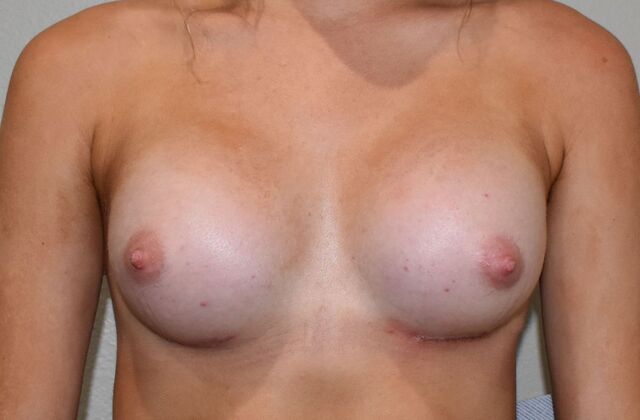 Breast Augmentation Case 740 - After