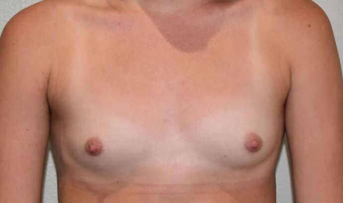Breast Augmentation Case 740 - Before