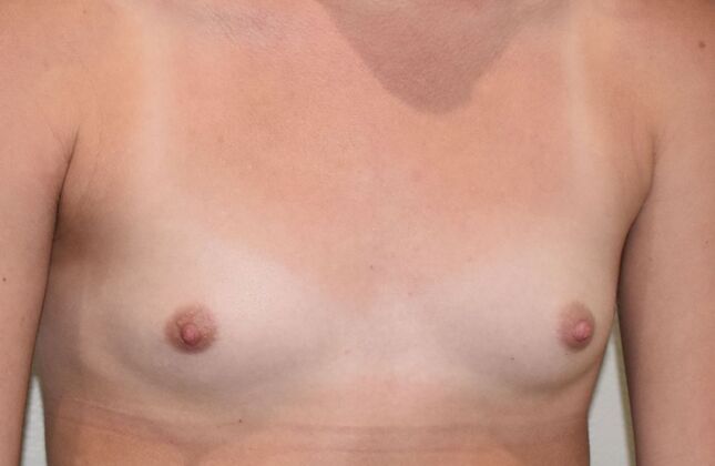 Breast Augmentation: Case 740 - Before