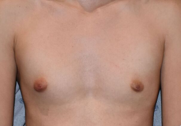 Breast Augmentation Case 762 - Before
