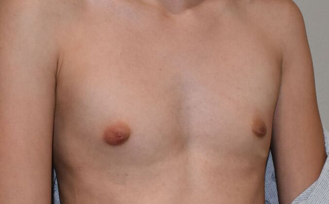 Breast Augmentation: Case 762 - Before