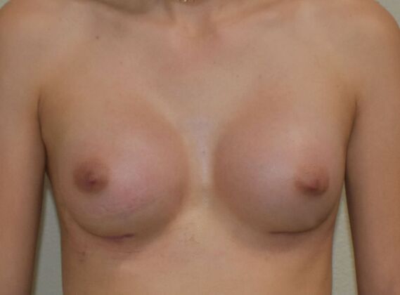 Breast Augmentation Case 762 - After