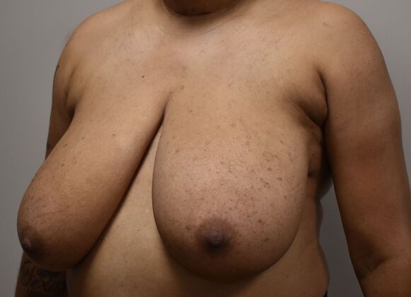 Breast Reduction: Case 178 - Before