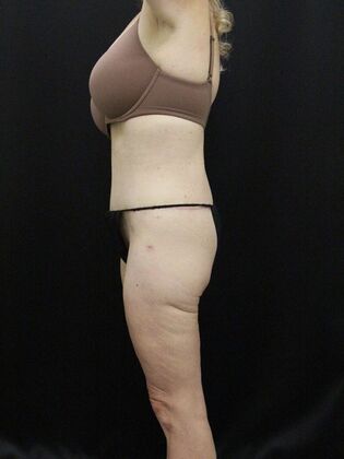 Body Lift: Case 4 - After