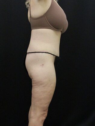 Body Lift: Case 4 - After