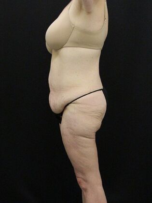 Body Lift: Case 4 - Before