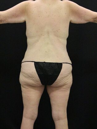 Body Lift: Case 4 - Before