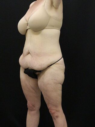 Body Lift: Case 4 - Before