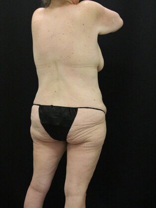 Body Lift Case 4 - Before