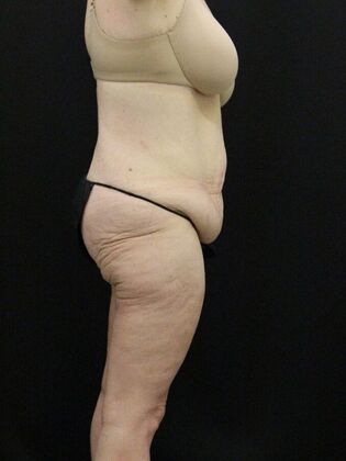 Body Lift: Case 4 - Before