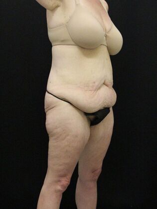 Body Lift: Case 4 - Before