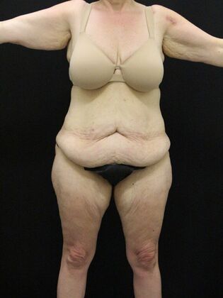 Body Lift: Case 4 - Before