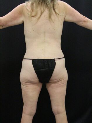 Body Lift: Case 4 - After