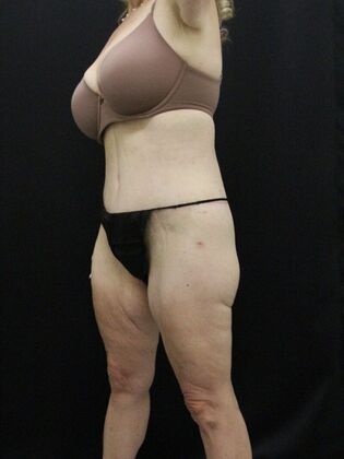 Body Lift: Case 4 - After