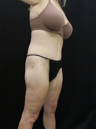 Body Lift: Case 4 - After