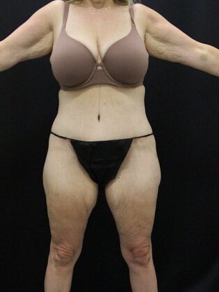 Body Lift: Case 4 - After