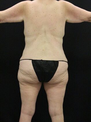 Tummy Tuck: Case 38 - Before
